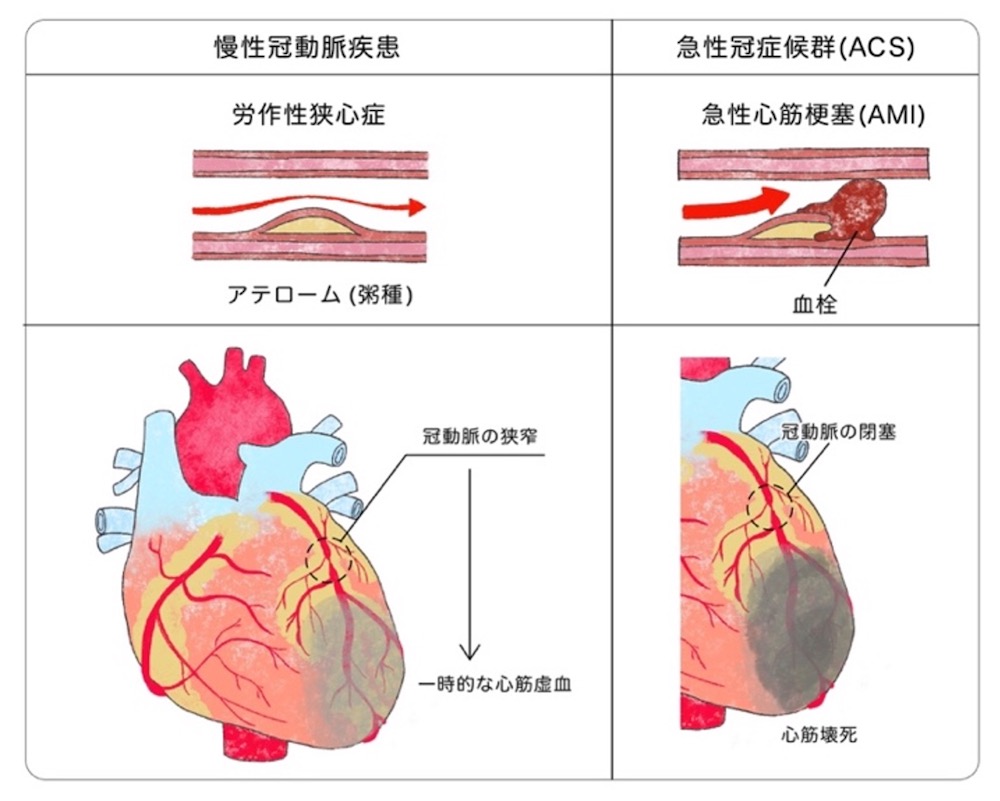 冠動脈バイパス術（CABG)｜順天堂医院 心臓血管外科