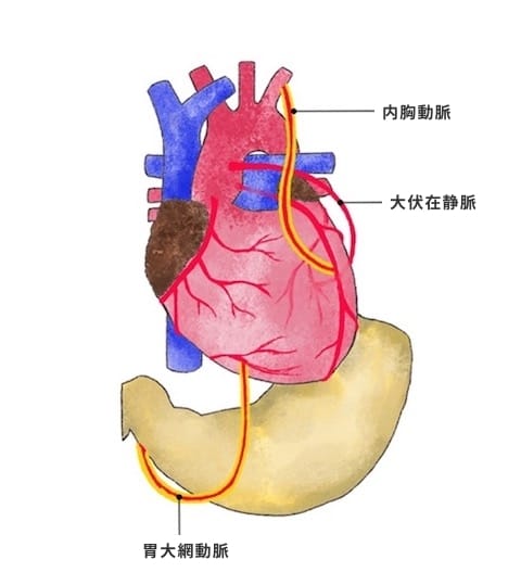 冠動脈バイパス術（CABG)