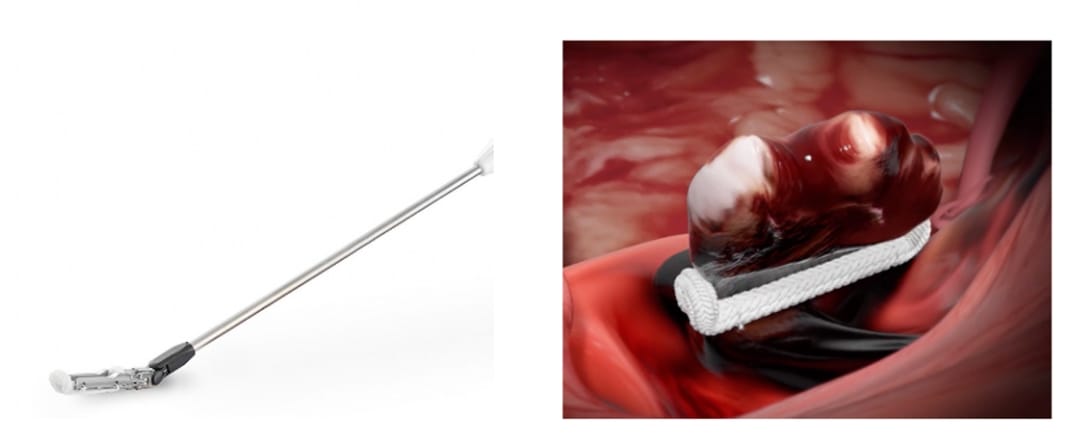 胸腔鏡下手術時の左心耳閉鎖術 (左心耳閉鎖用クリップ : Century Medical社)
