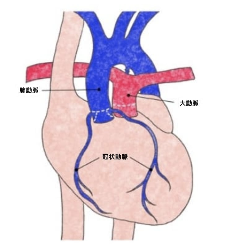 完全大血管転位の解剖